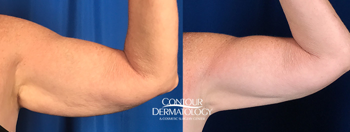 CoolSculpting for Arms, 3 months after 1 treatment