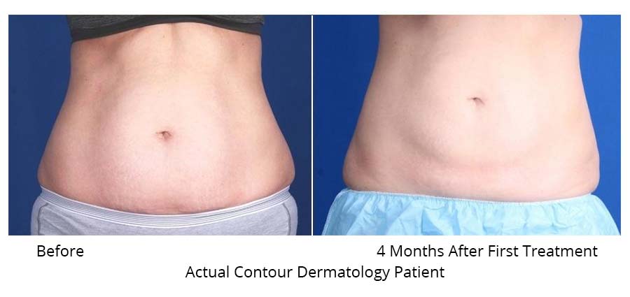 Before and After front abdomen CoolSculpting