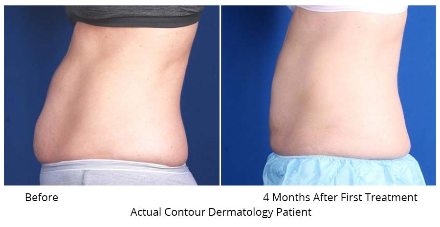Abdomen Before and After CoolSculpt