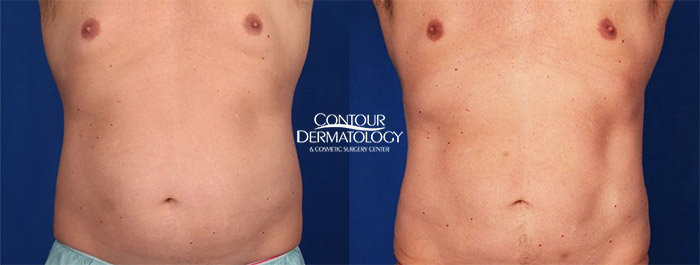 Cool Sculpting for abdomen, Man, 6 months after 3 treatments