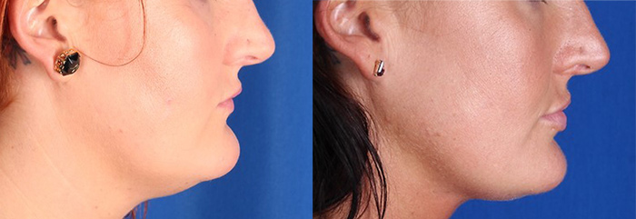 CoolSculpting for Chin, 3 Months After 2 Treatments
