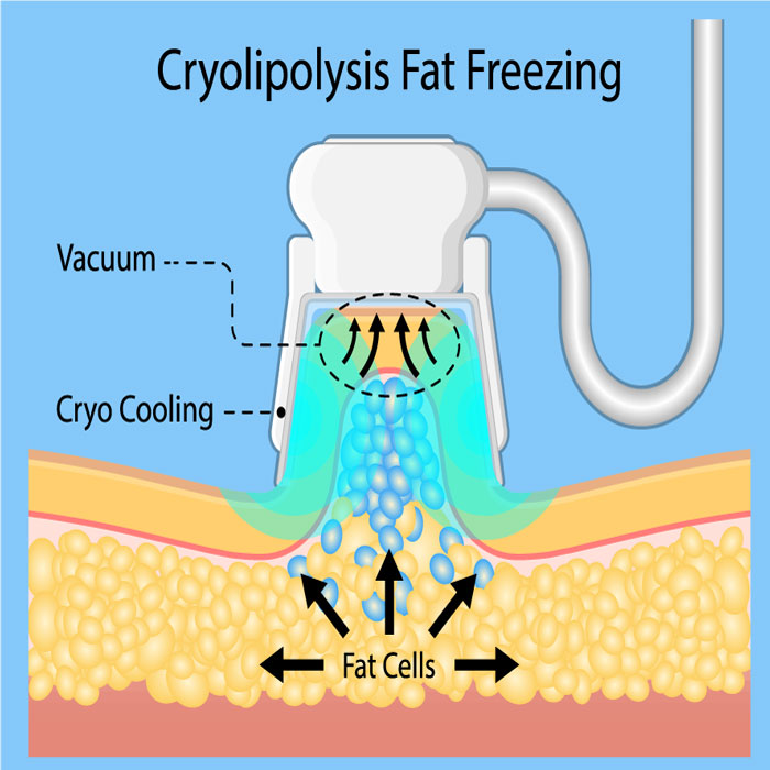Cryolipolysis Fat Freezing CoolSculpting
