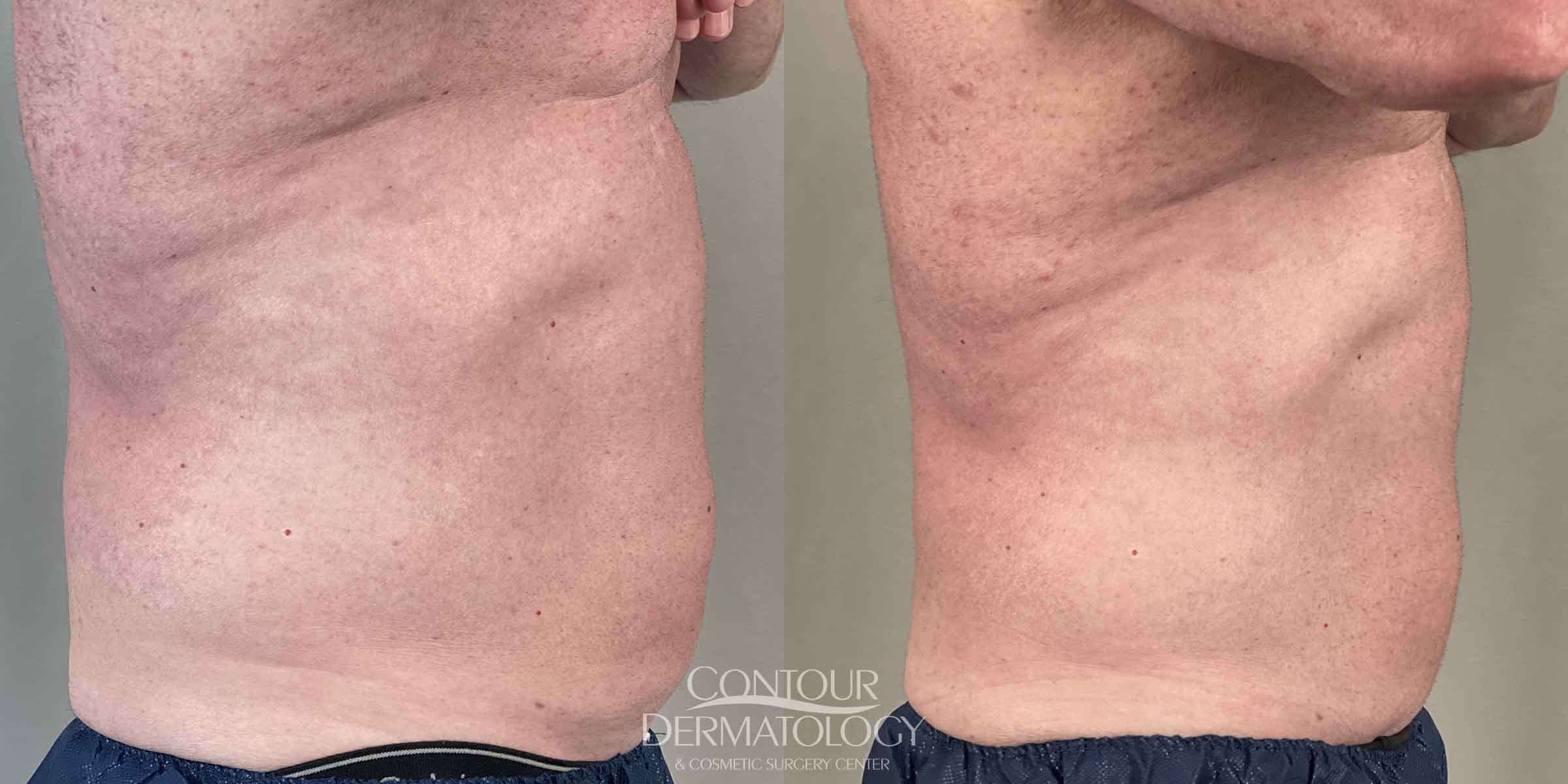 CoolSculpting for abdomen - man